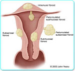 Fibroid Locations